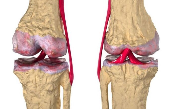 Kelio sąnario osteoartritas